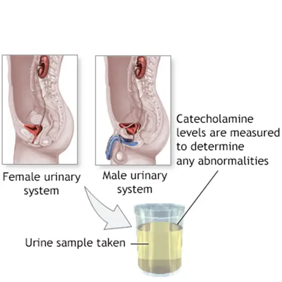 Catecholamines & VMA 24 Hour Urine